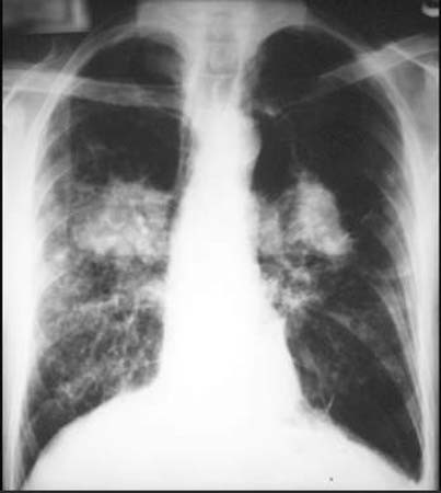 Pulmones repletos de moco
